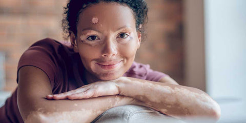 Le Vitiligo causes, symptômes et remèdes naturels